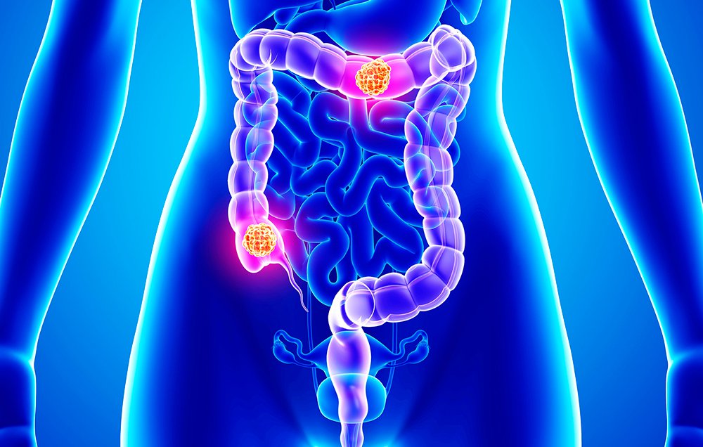 Colon Stomach, Soft Tissue Diseases